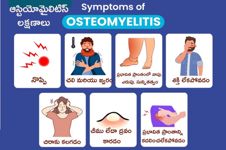 Symptoms of Osteomyelitis