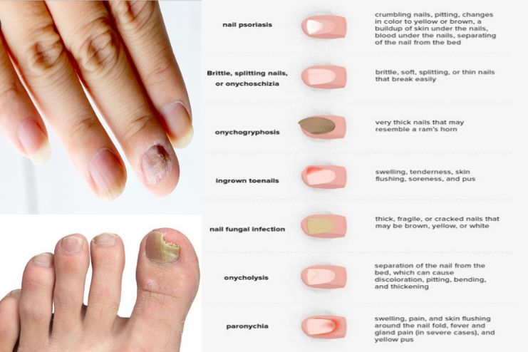 Symptoms of a nail infection