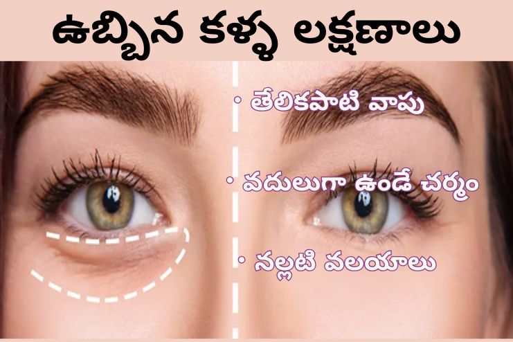 Symptoms of bags under eyes