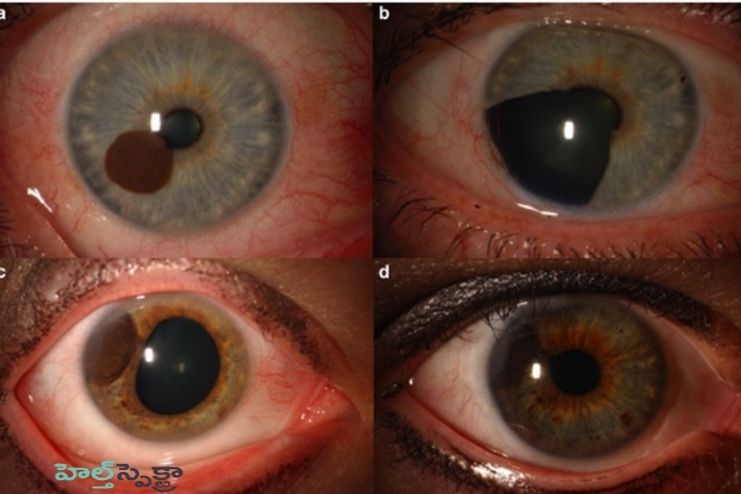 Symptoms of eye melanoma