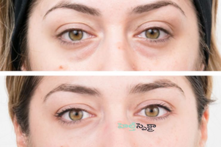Therapies for bags under eyes