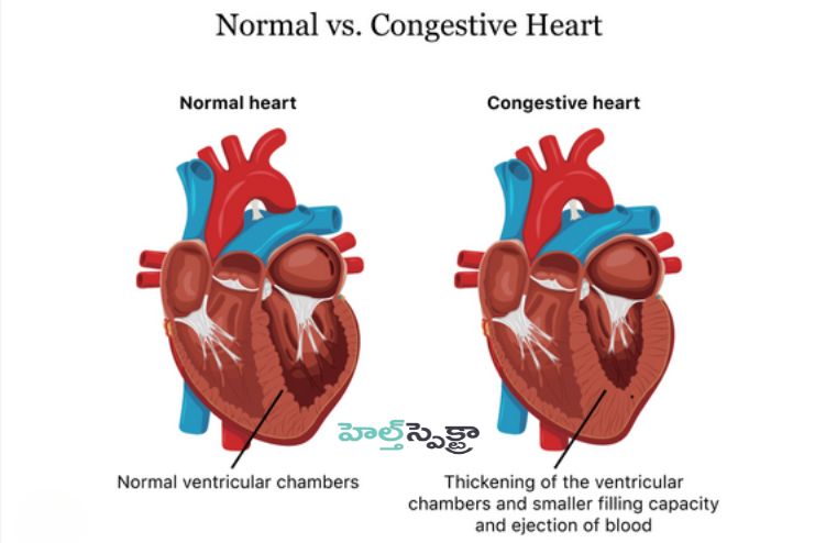 Treating congestive heart failure