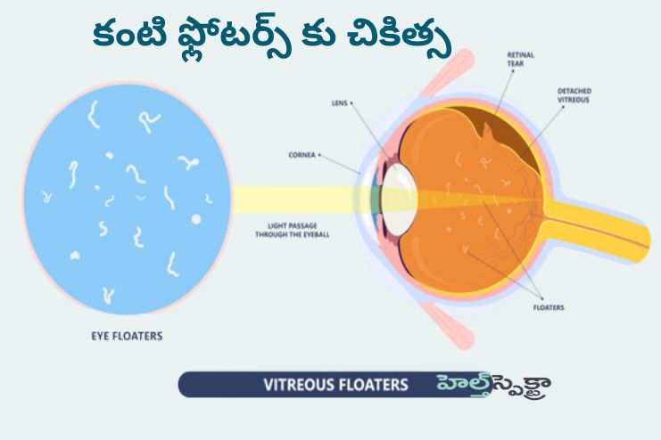 Treatment for Eye floaters