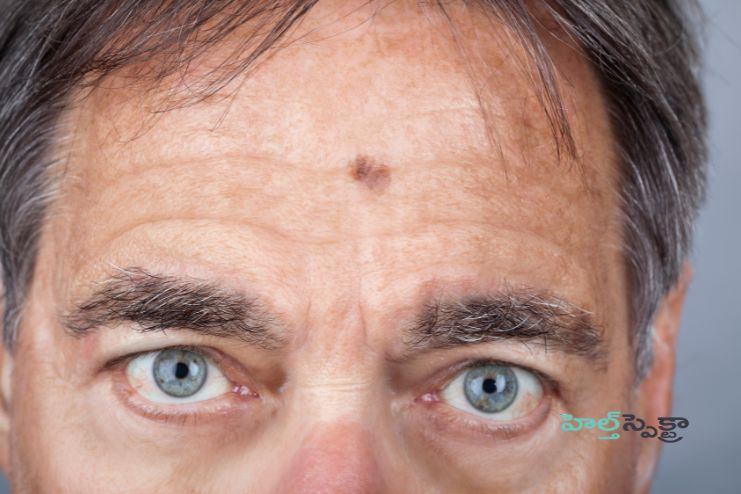 Treatment for Eye melanoma