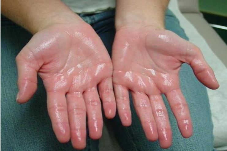 Treatment for Hyperhidrosis