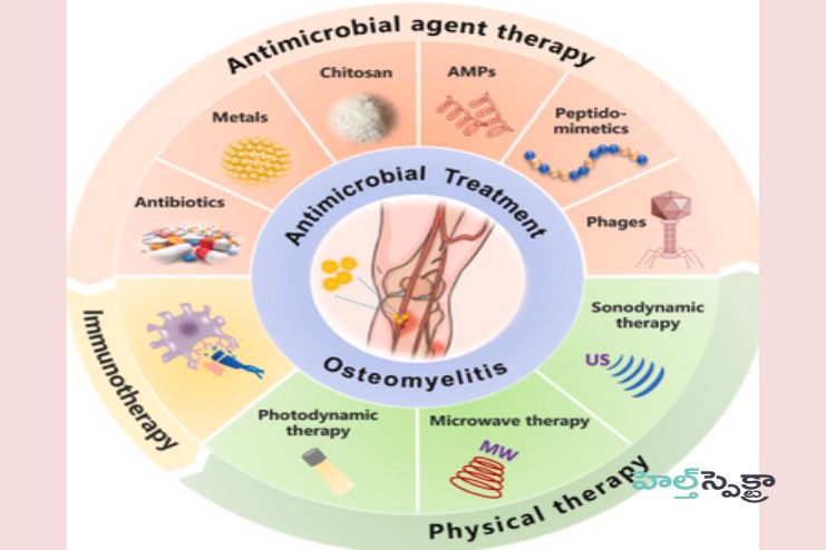 Treatment for Osteomyelitis 2