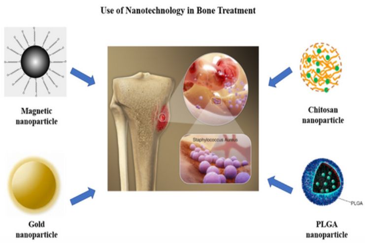 Treatment for Osteomyelitis