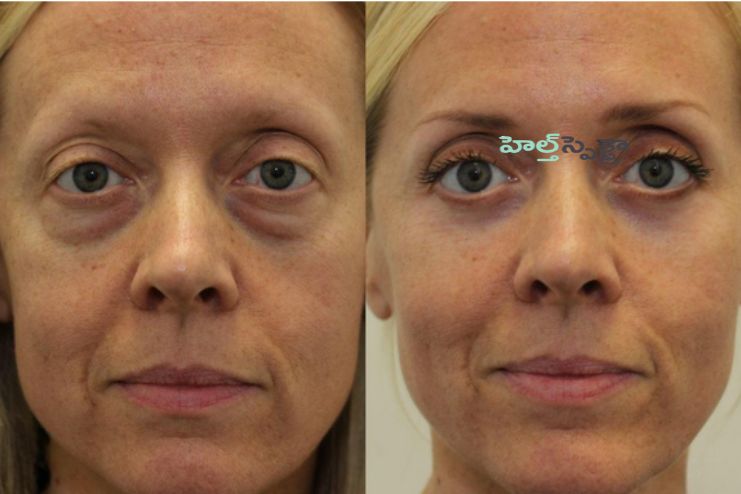 Treatment for bags under eyes