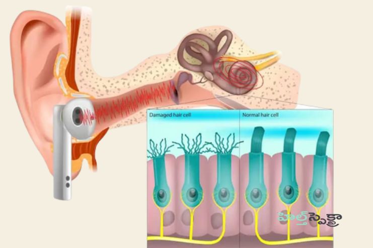 Treatment of Hearing Loss