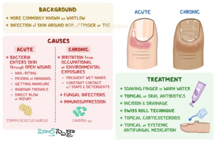What are the types of paronychia