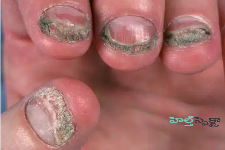 What is a nail infection