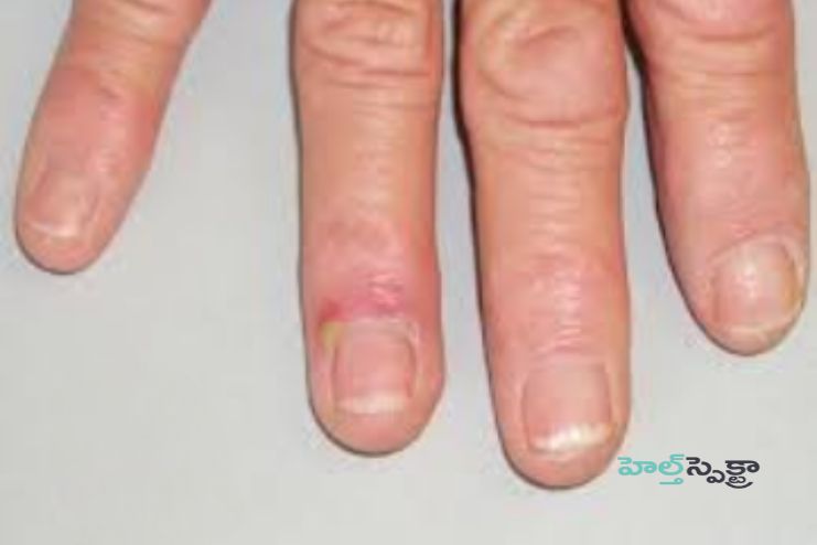 What is the outlook for people with paronychia