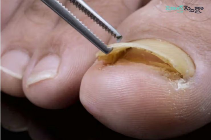 What is the treatment for paronychia