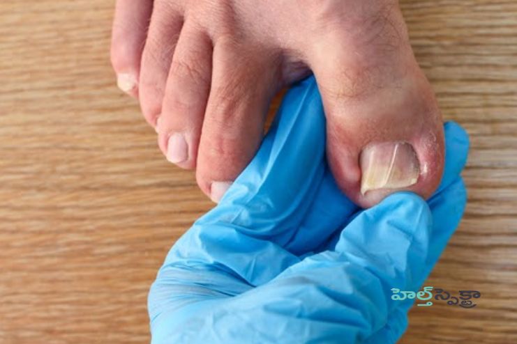 When should I see Doctor about paronychia