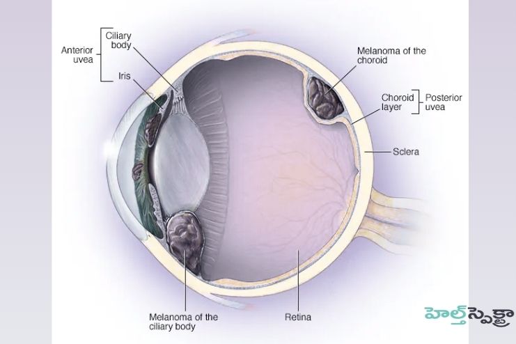 Where eye melanoma develops