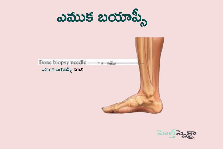 bone biopsy