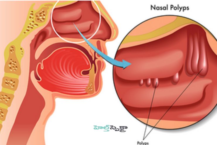 Causes of Nasal polyps
