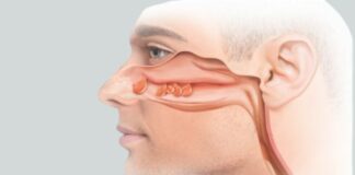 ముక్కులో పాలిప్స్: కారకాలు, లక్షణాలు మరియు చికిత్స - Nasal polyps: Causes, Symptoms and Treatment Nasal polyps_ Causes, Symptoms and Treatment