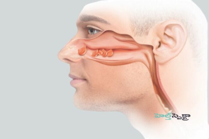 Nasal polyps_ Causes, Symptoms and Treatment