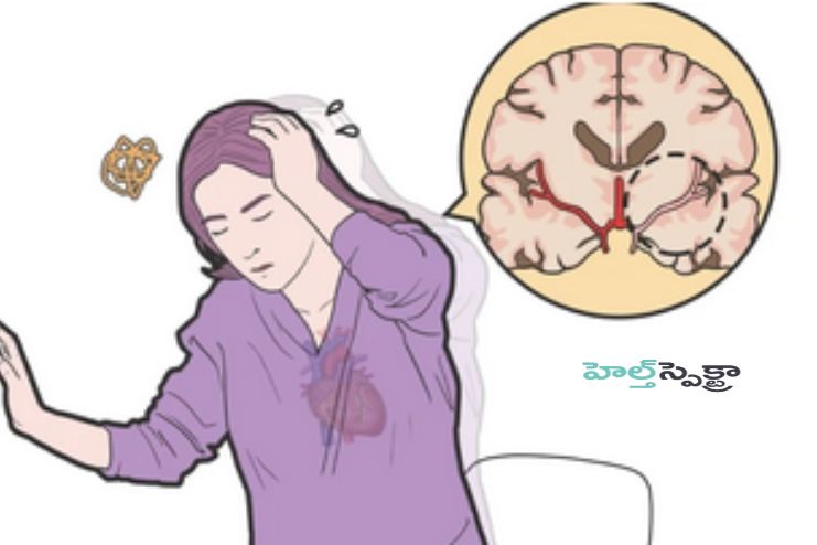 Orthostatic hypotension
