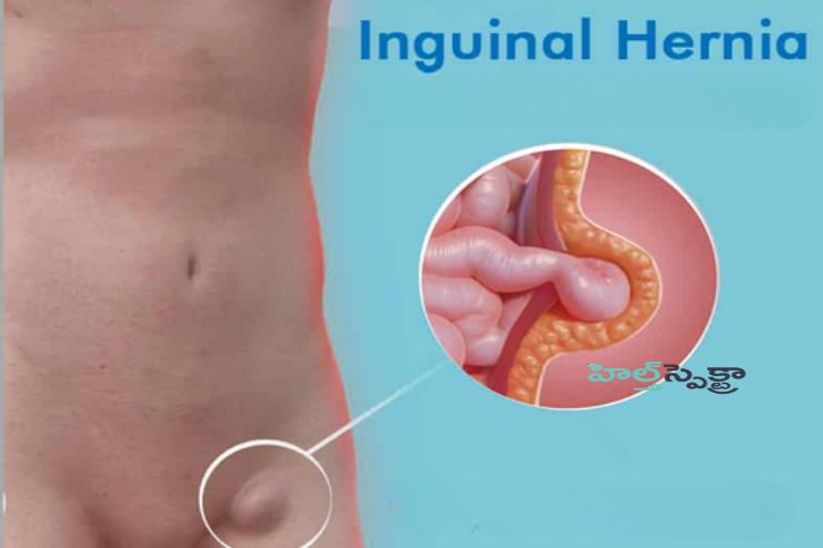 Other symptoms of inguinal hernia