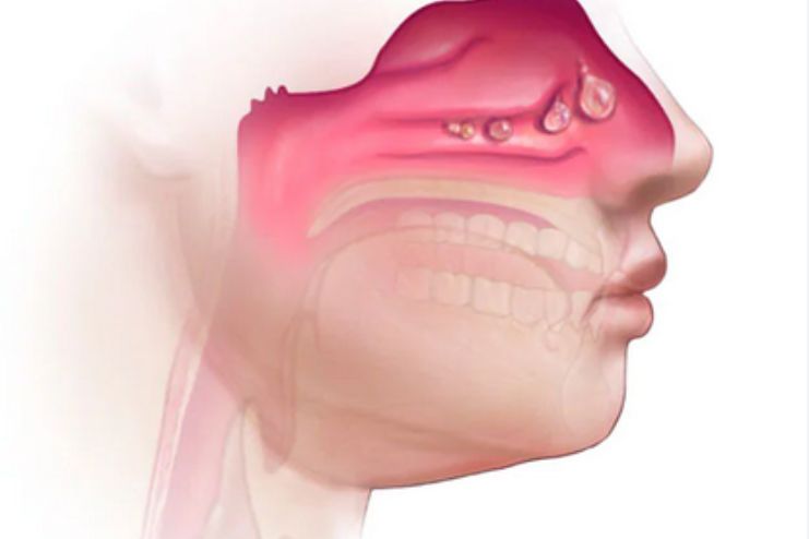 Prevention of Nasal polyps