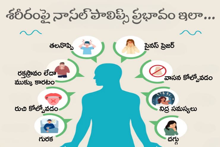 Risk factors of Nasal polyps