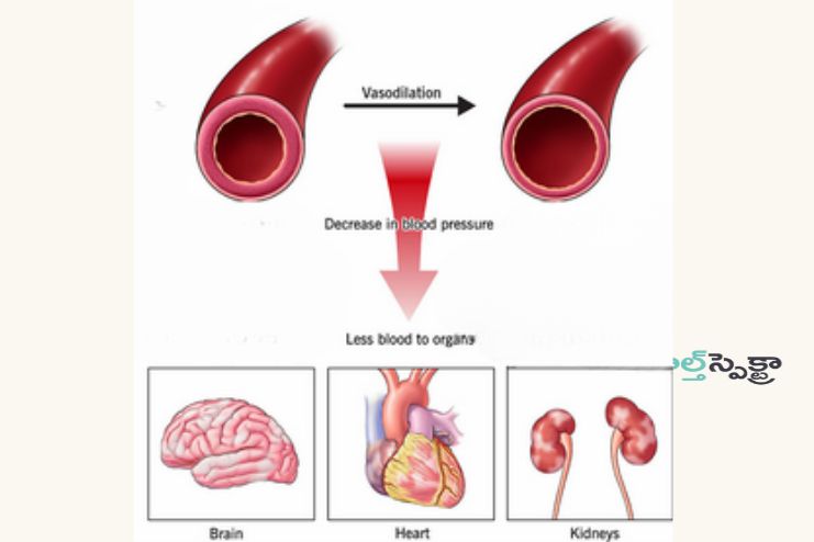 Severe hypotension linked to shock