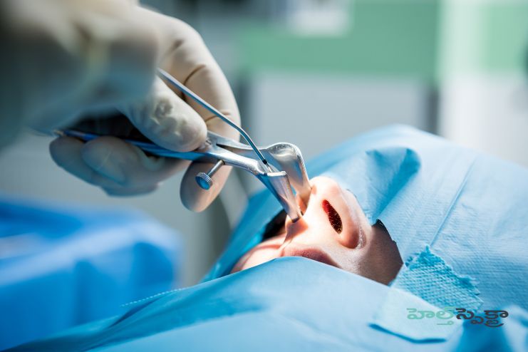 Surgery to remove the Nasal polyps