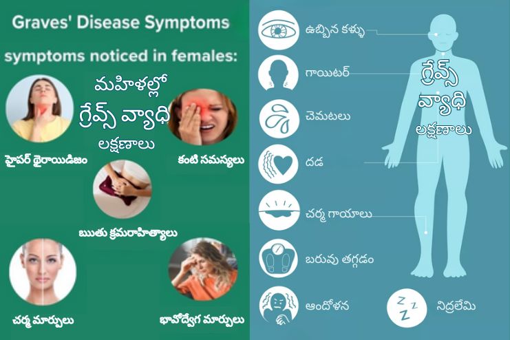 Symptoms of Graves' disease