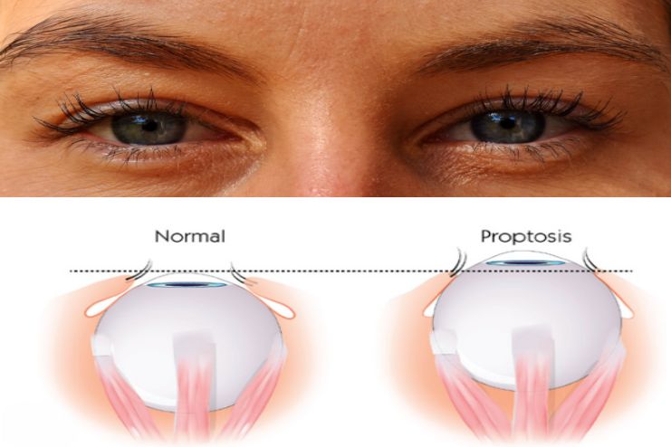 Treatment for thyroid eye disease