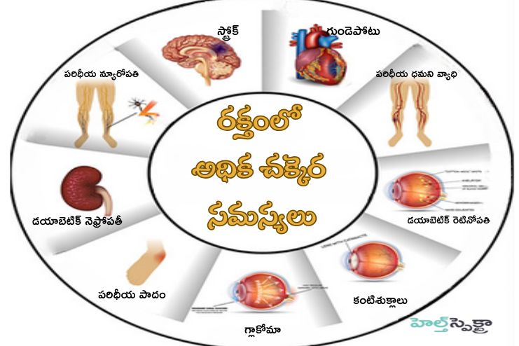 Complications of T2DM