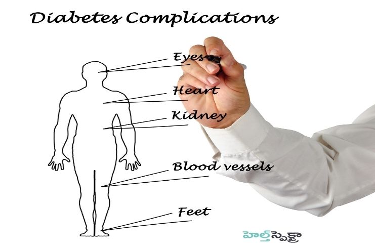 Consequences of high glucose in the blood (2)