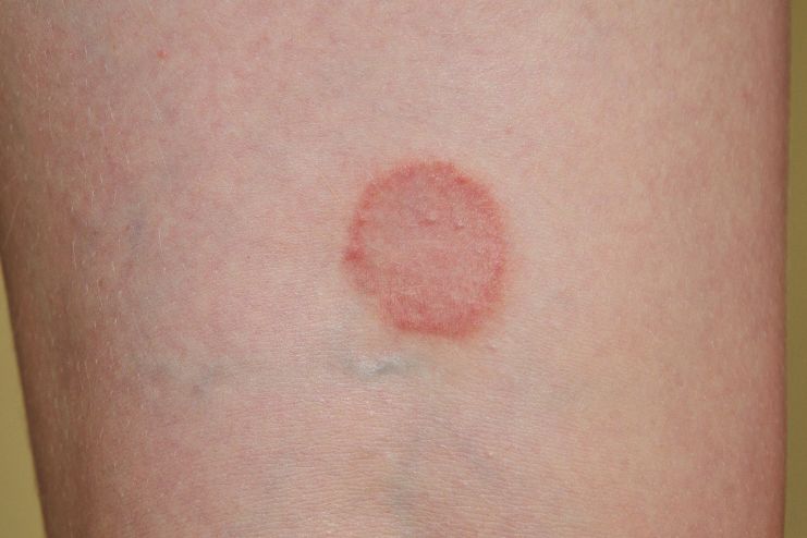 Lichen planus