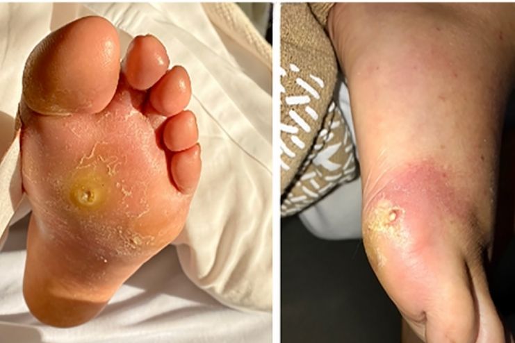 Recurrent infections