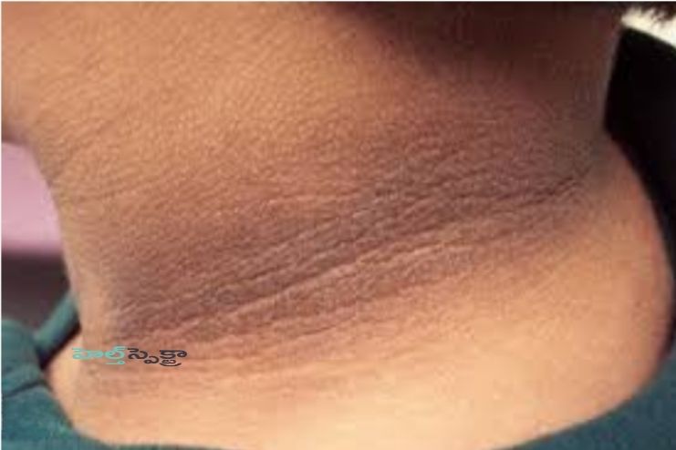 Darker skin on the neck