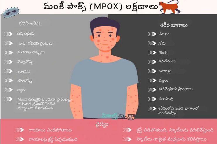 What are the symptoms of mpox