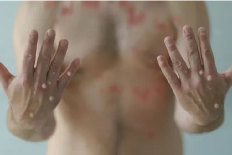 What happens if you have mpox