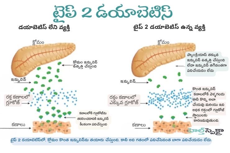 What happens in Type II Diabetes