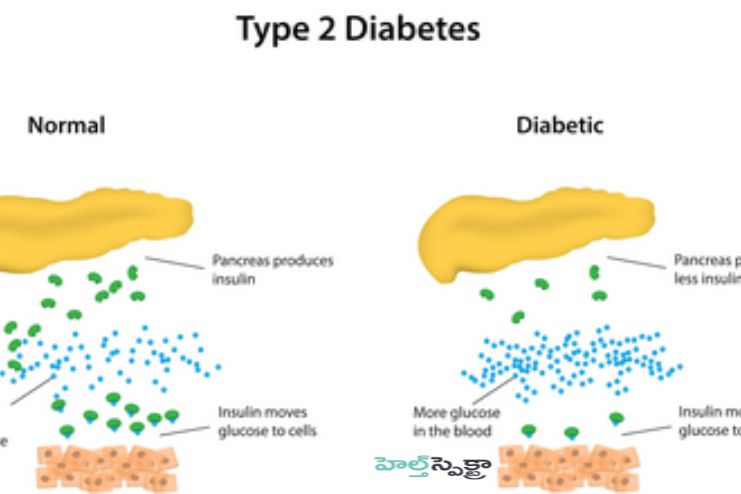 What happens in type 2 diabetes