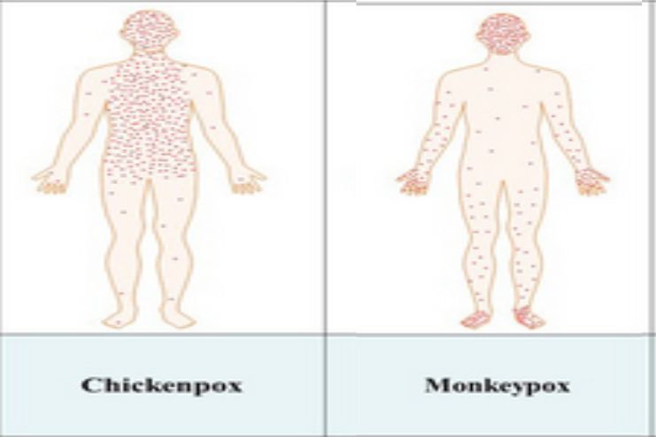 mpox vs. Chickenpox