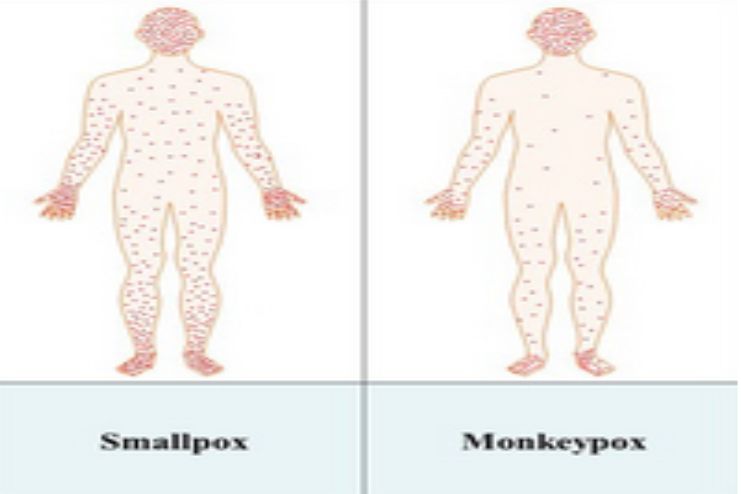 mpox vs. smallpox