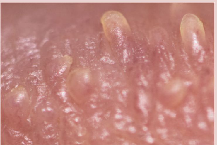 pearly papules