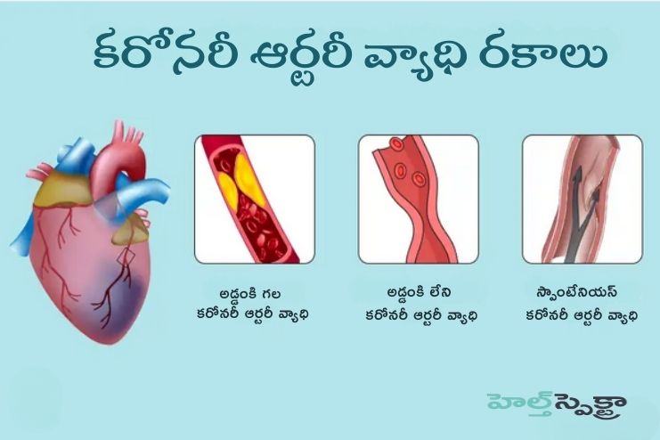 types of coronary artery disease