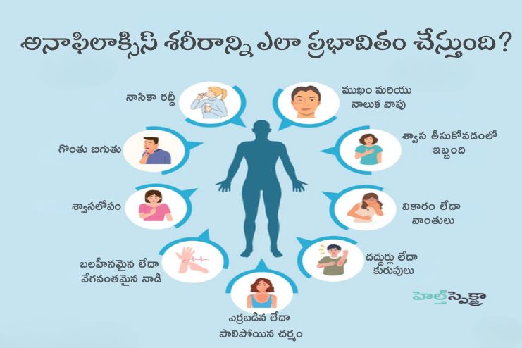 Anaphylaxis_ Symptoms and what to do