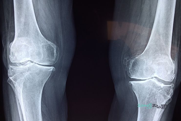 Bone density loss
