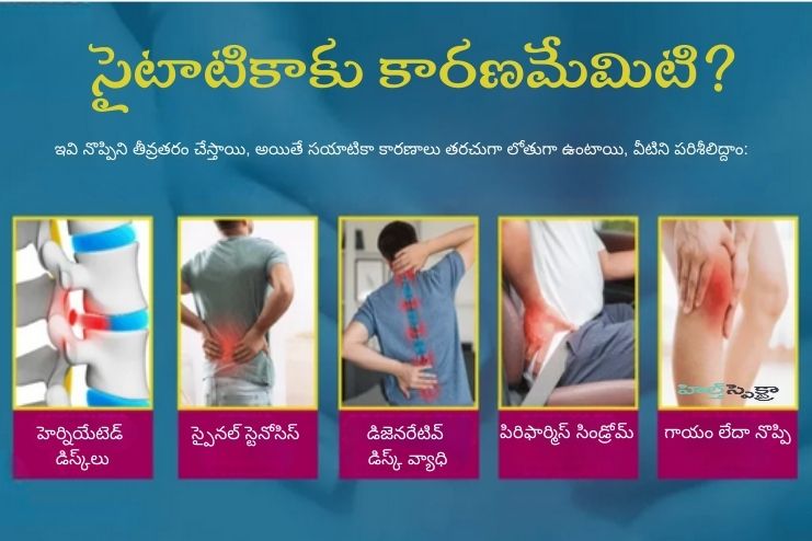 Causes of Sciatica pain