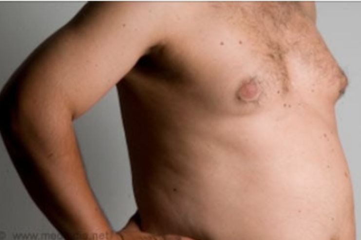 Causes of male breast cancer