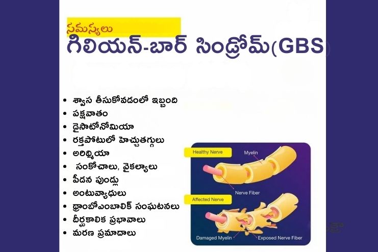 Complications of Guillain-Barre syndrome