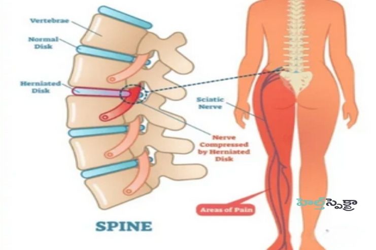 Complications of Sciatica pain